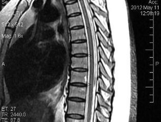 გულმკერდის ხერხემლის MRI